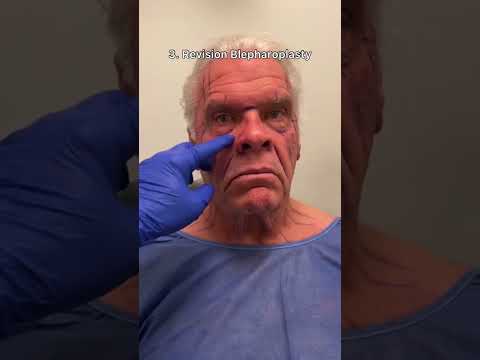 Major Male Facelift Transformation! Watch until the end 😱😍